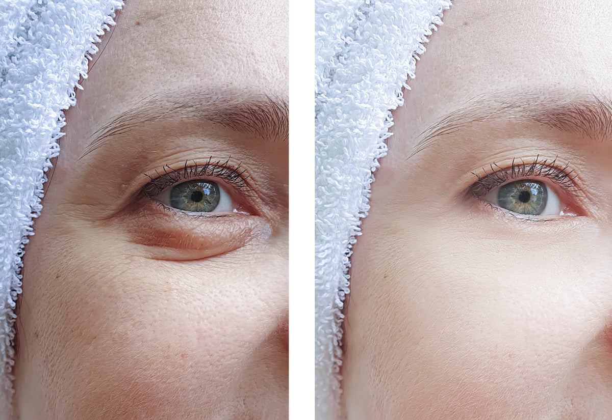 How to Reduce Puffy Eyes - Luma by Laura